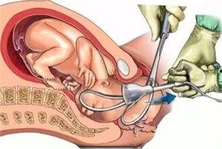 产钳视频,直观展示分娩时刻