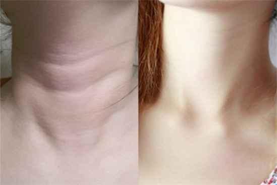 怎样消除颈纹视频教程,跟随视频教程，恢复颈部紧致与年轻态